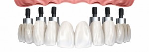 Clinica Bpd - Implante Dentario pneumologista gaia - alergologista gaia - Dentista Gaia